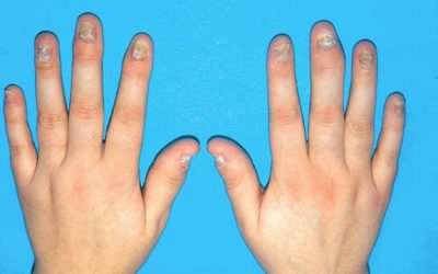 ARTRITIS PSORIÁSICA